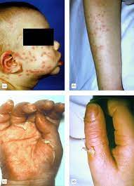 Complications Of Kawasaki Disease Sciencedirect