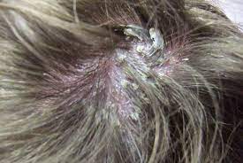 It does not result in scarring or alopecia. Dermatology Five Pictorial Cases And Outcomes Gponline