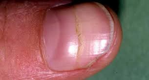 Nail Abnormalities Symptoms Causes And Prevention