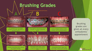Wash mouth with salt water. About Braces Lincoln Ne Dr Rebecca H Hohl Dds Ms