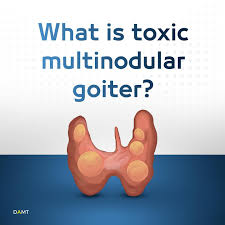 Image result for Multinodular Goiter