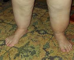 Umstellung auf serienmäßige bpw achsen bietet viele vorteile. Lipodem Nhi No