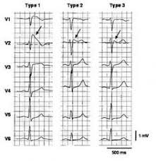 7 Best Brugada Syndrome Ideas Brugada Syndrome Syndrome Medical