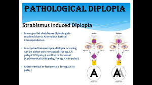 Image result for Diplopia
