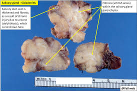 Image result for Sialolithiasis