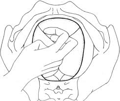 Image result for Manual Rotation in Occipitoposterior Presentation