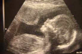 En la semana 22 de embarazo, tu útero puede que ya haya superado el ombligo. Club Madres Semana 26 Ya Esta En Posicion Fetal