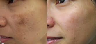 Image result for Mild PIH Management