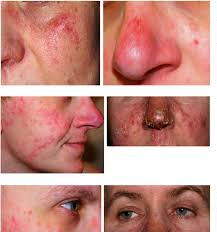 Image result for demodex rosacea