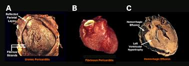 Image result for Pericarditis