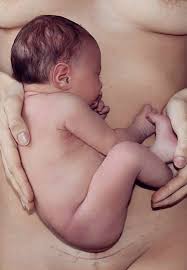 Kdvr reazjhana williams had planned to have a natural birth, before doctors were unable to find a. C Section Scar Photos