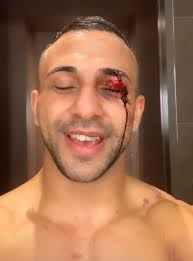 Pictures show brutal results of bare knuckle boxing title fight