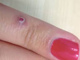 Definiciones Dermatologia Archives Seite 105 Von 233 Dermatly Com El Sitio De Tu Piel