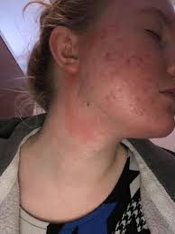 Other users noticed little or no hair loss and found that they needed to use an alternative hair removal method. Superdrug Investigates Mum S Claim Acne Gel Left Her With Chemical Burns Deadline News