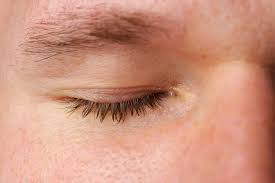 Image result for xantelasma