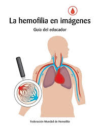 Without enough factor ix, the blood cannot clot properly to control bleeding. La Hemofilia En Imagenes World Federation Of Hemophilia