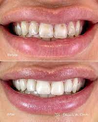 Brown Stains Decay Discolored Front Teeth She Wished For A Same Day Transformation Decay Remove Dental Veneers Restorative Dentistry Cosmetic Dentistry