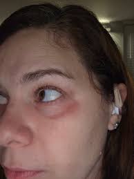 Hello ladies! I had saline breast implants for 16 years. 8 months after I  got them in a started having weird unexplained issues