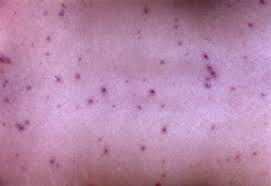 Image result for chickenpox