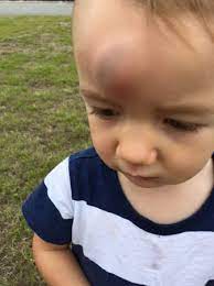 Lo Hit Forehead Giant Goose Egg Babycenter