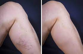 How To Get Rid Of Varicose Veins Premier Vein Clinic