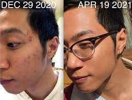 B A Selfie Cystic Acne Breakout Left Behind Some Pretty Gnarly Post Inflammatory Hyperpigmentation Didn T Realize How Much My Skin Had Improved Since Until I Compared These Selfies Skincareaddiction