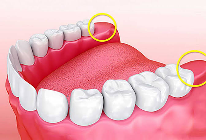 mọc răng hàm dưới trong cùng