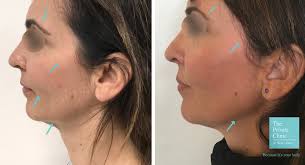 I hated that i had jowls. Sagging Jowls Treatment Liposuction For Sagging Jowls And Double Chin