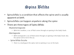 Birth Defects Frank Zuniga Ppt Video Online Download