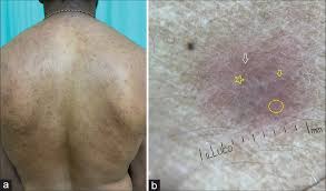 Image result for Secondary Syphilis