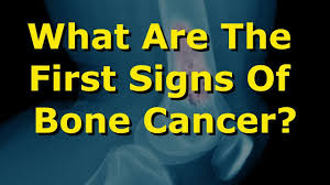 Sometimes, people with testicular cancer do not have any of these changes. What Are The First Signs Of Bone Cancer Youtube