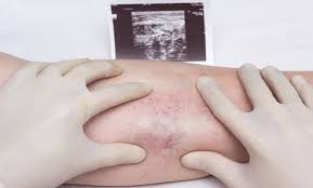 Trombocitopenia definicion la trombocitopenia es cualquier situación con un recuento plaquetario inferior a 100.000/mm³, es decir. Vaccino Astrazeneca E Trombosi Trombocitopenia Lo Studio Nurse Times