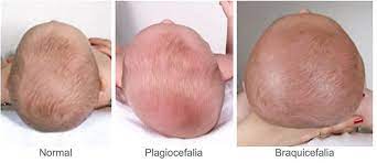 ¿quién refusal ha tenido tortícolis linear unit cierto momento, sobre todo luego de sobrevenir mantenido una mala postura durante. Plagiocefalia Y Torticolis Congenita Y Como Tratarla Vital Clinic