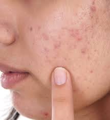 Diagnosis And Treatment Of Acne Scars Schweiger Dermatology Group