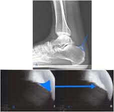 Piñol v, castells a, andreu m et al./accuracy of the revised bethesda guidelines, microsatellite instability, and immunohistochemistry for the identification of patients with. Minimally Invasive Achilles Haglund S Syndrome And Endoscopic Calcaneoplasty Orthovirginia