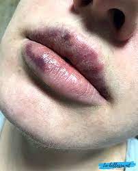 Pre svake intervencije neophodno je uraditi detaljan klinički pregled i odrediti šta se i kako koriguje. Modrice Nakon Hijaluronske Kiseline Povecavaju Se Uzroci Lijecenje Ljepota I Zdravlje