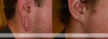 Sometimes, a small portion of tissue gets torn from the ear during a traumatic injury. Earlobes Repair Philadelphia Pa Torn Ear Lobe Main Line