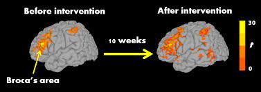Social communication deficits present in various ways and can include impairments in joint attention and. Autistic Children Improved Reading And Brain Activity After 10 Week Reading Intervention