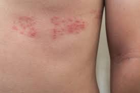 Image result for shingles