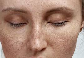 Image result for Freckled skin