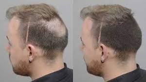 Bald Spot Quick Fix With Forila Hair Loss Concealer Hair Thickening Fibers Hair Fibers