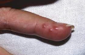 Learn vocabulary, terms and more with flashcards, games and other study tools. Can I Get Genital Herpes From Someone S Hands Quora