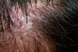Image result for folliculitis symptoms