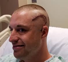 Some types of brain tumors grow rapidly; Brain Tumor Surgery In Iran Brain Cancer Surgery Free Consultation