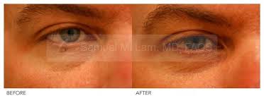 Mole Removal Photo Eyelid Mole Removal And Facial Excisions Procedures By Dr Samuel Lam Lamfacialplastics Lamfaci Mole Removal Facial Rejuvenation Facial