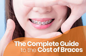 Price may vary depending on various factors. The Complete Guide To The Cost Of Braces Blog Asian Sun Dental Clinic Manila