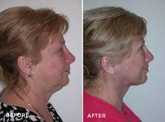 23 FACELIFTS ideas