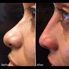 Perempuan tentu ingin tampil cantik dan sempurna. Lihat 7 Transformasi Wanita Berhidung Pesek Jadi Mancung Foto 7