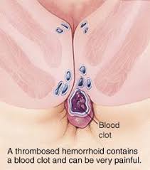 Thrombosed hemorrhoids is a type of hemorrhoid with a clot that partially or fully blocks blood flow. Hemorrhoids Org Thrombosed Hemorrhoids