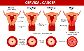 Fortunately, the cervical cancer death rate has dropped by over 50% over the last 50 years, partially due to early screening. 4 Warning Signs Of Cervical Cancer You Shouldn T Ignore Healthy Food House